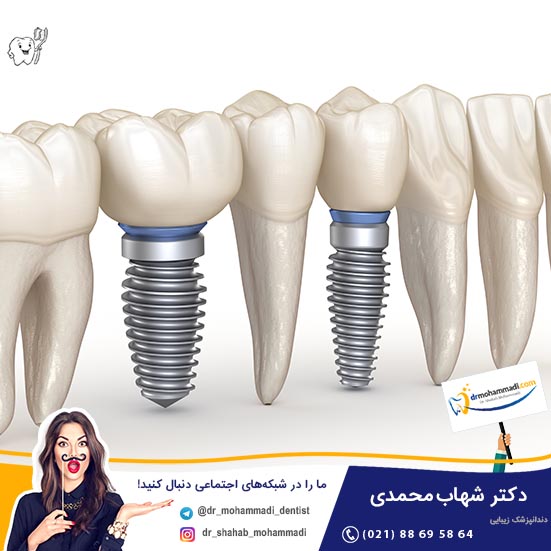 بدترین و ساده ترین مشکلات ایمپلنت چیست؟ - کلینیک دندانپزشکی دکتر شهاب محمدی
